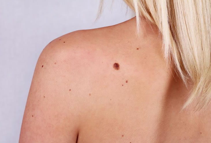 Tot ce trebuie sa stii despre alunite. Tipuri si tratament
