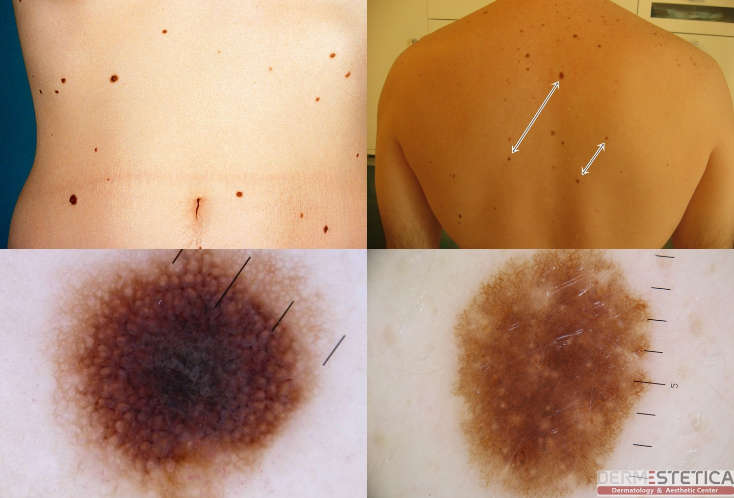 Dermatoscopie digitală FotoFinder – Clinica Dermestetica